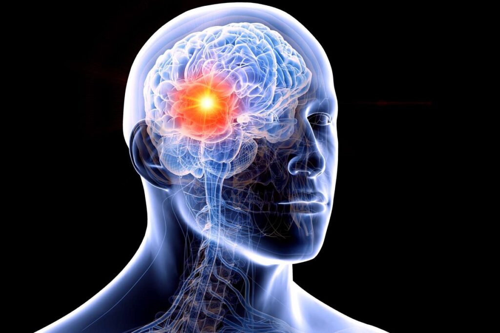 cancer du cerveau