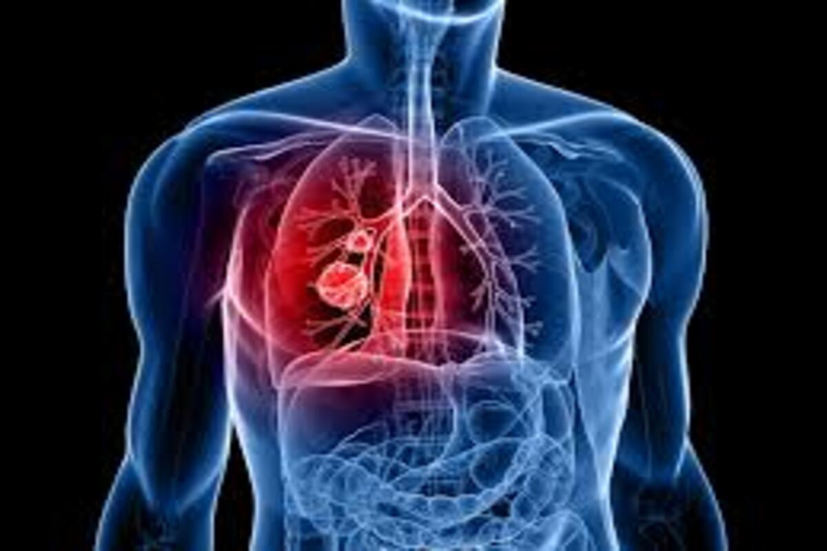 Cancer du poumon : bonne nouvelle, un vaccin révolutionnaire en cours de test