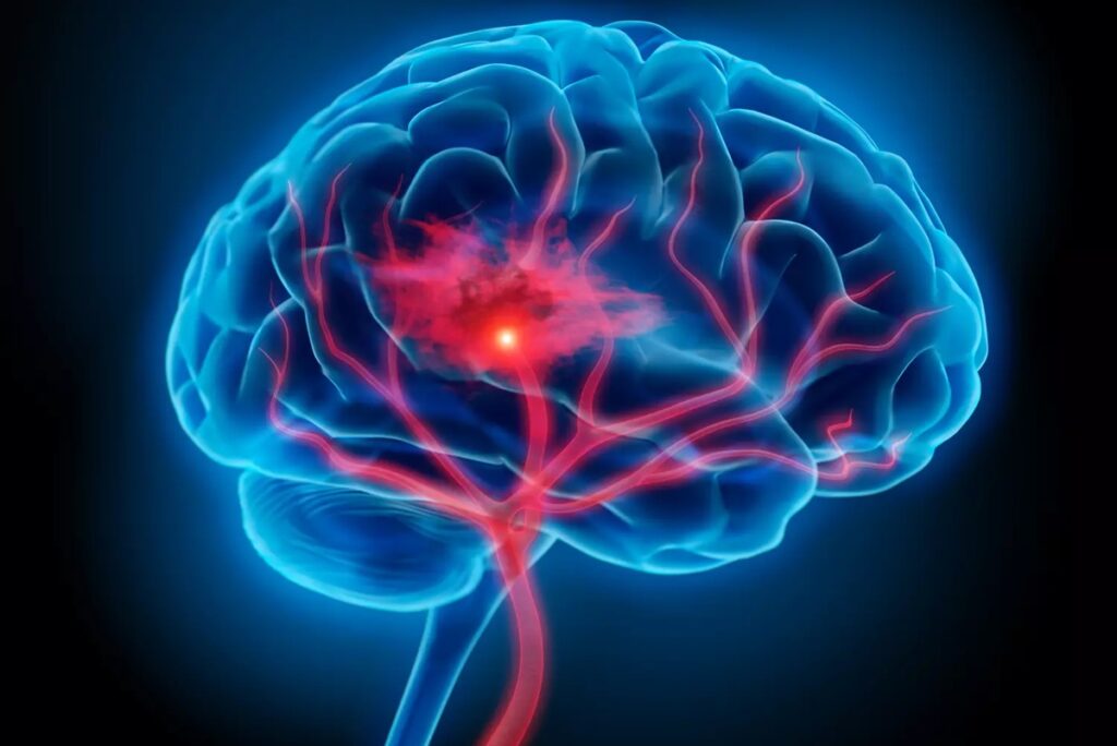 Côte d'Ivoire Dr Marie Beuseize Avant 50 ans, les hommes ont plus de risque de faire un AVC que...