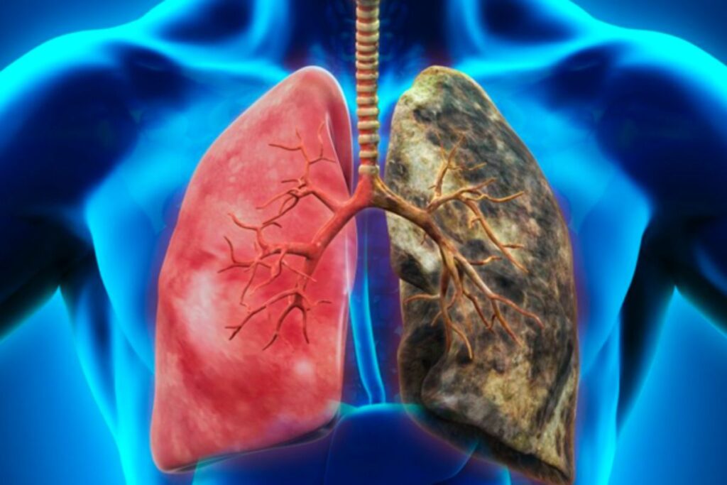 ‎Cancer du poumon Afrique du Nord