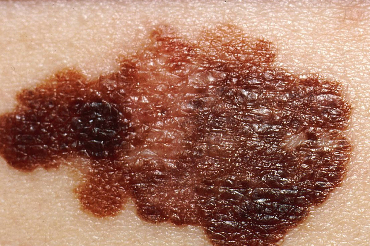 cancer de la peau